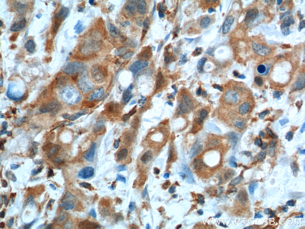 IHC staining of human liver cancer using 60317-1-Ig