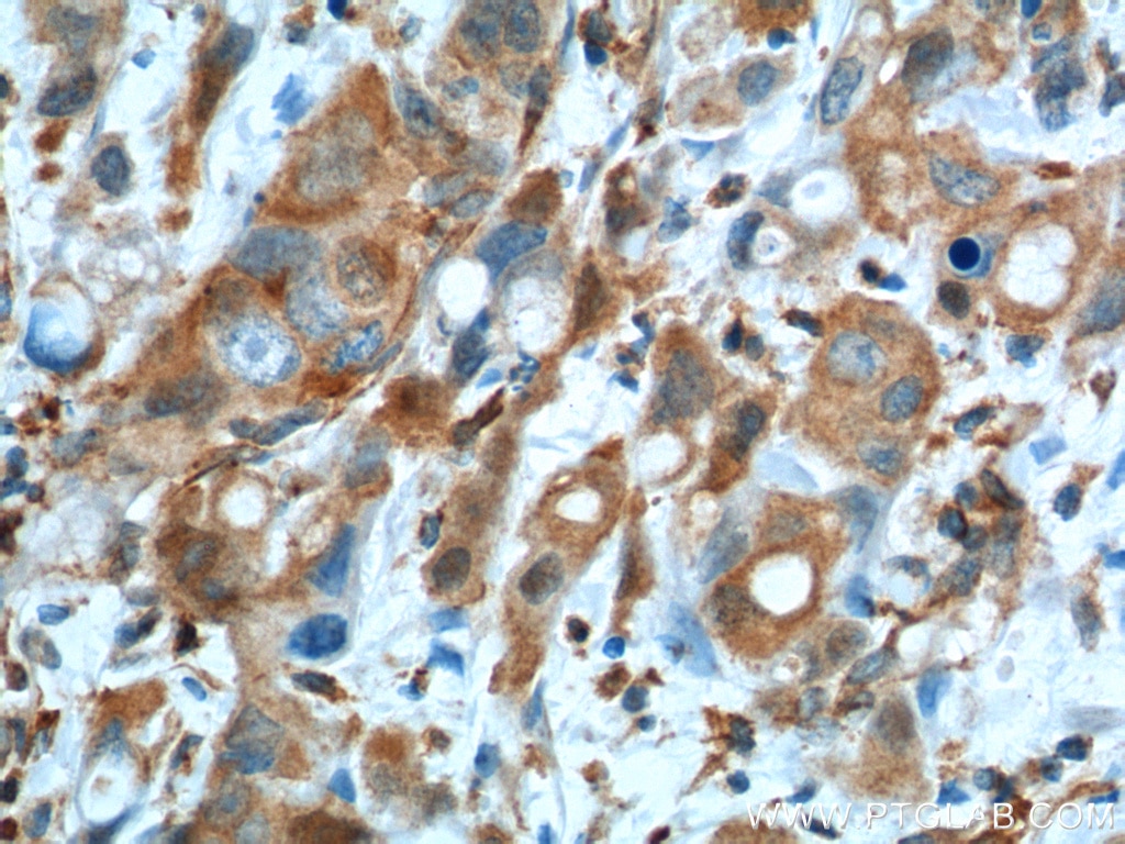 Immunohistochemistry (IHC) staining of human liver cancer tissue using GOT1 Monoclonal antibody (60317-1-Ig)