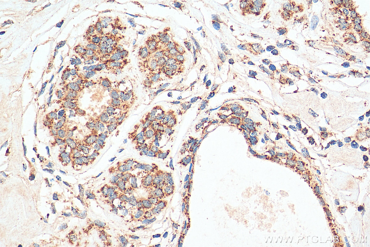 Immunohistochemistry (IHC) staining of human breast cancer tissue using GOT2 Polyclonal antibody (14800-1-AP)