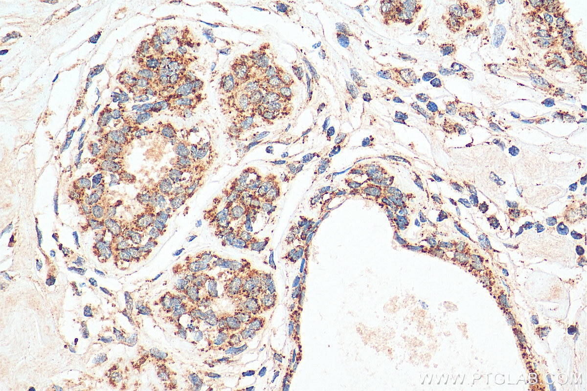 IHC staining of human breast cancer using 14800-1-AP