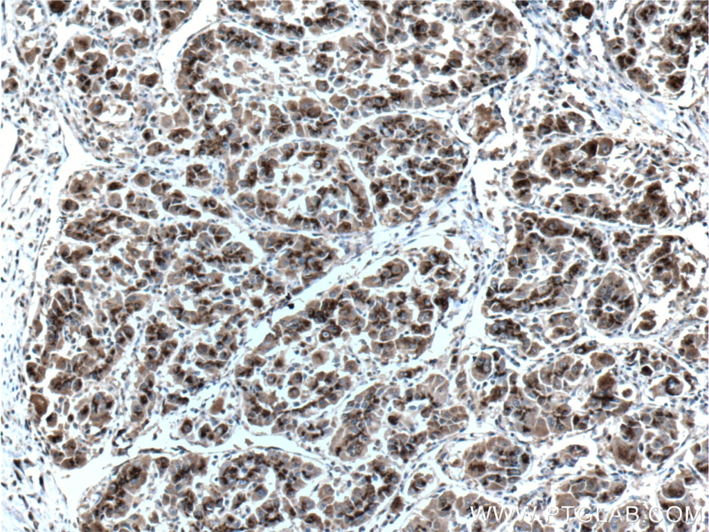IHC staining of human liver cancer using 66331-1-Ig