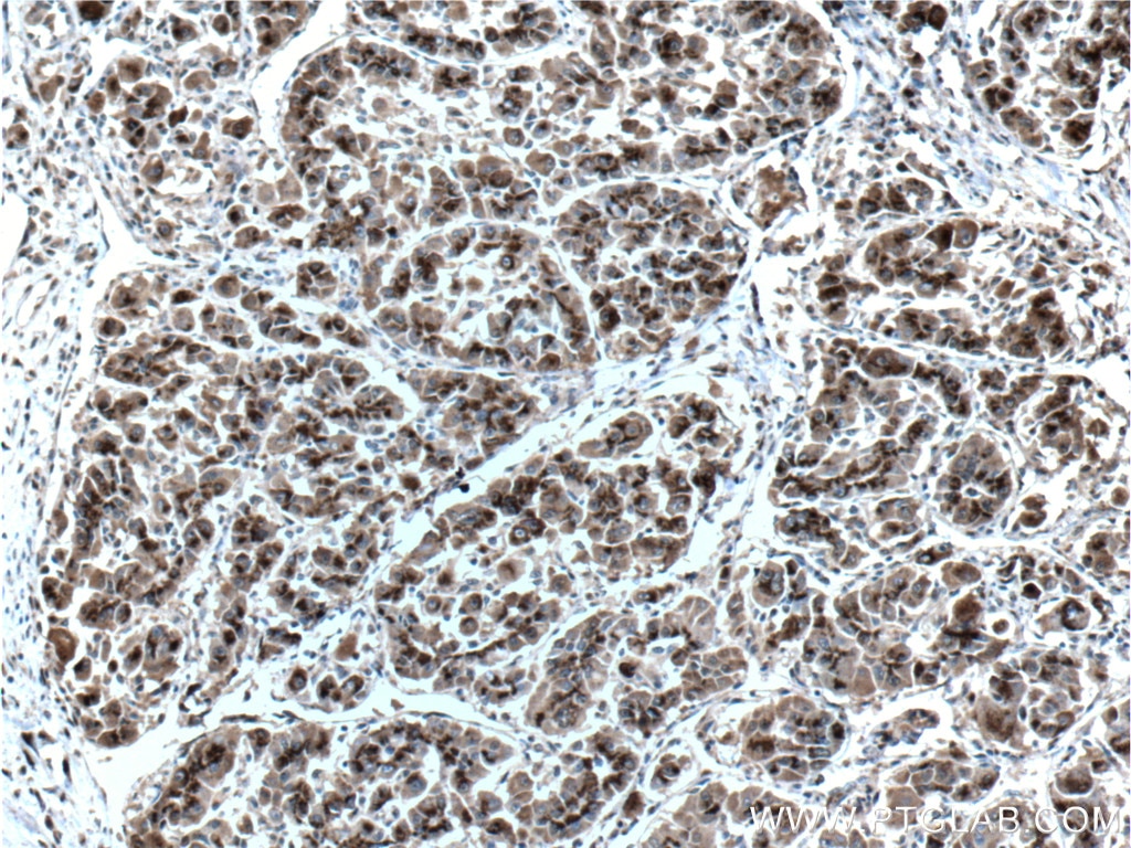 Immunohistochemistry (IHC) staining of human liver cancer tissue using GP73/GOLPH2 Monoclonal antibody (66331-1-Ig)