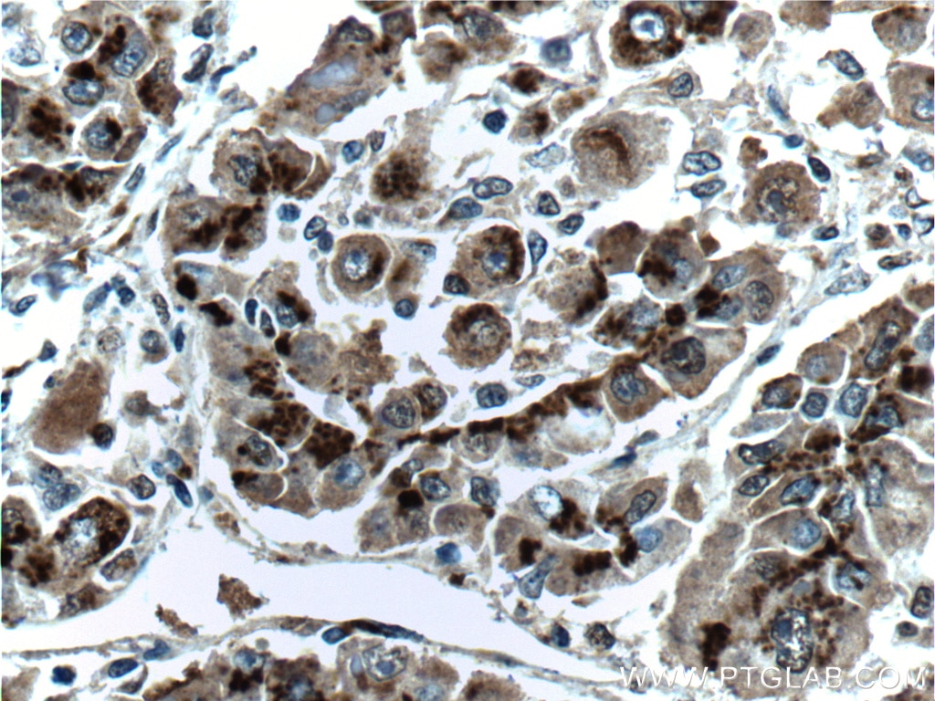 Immunohistochemistry (IHC) staining of human liver cancer tissue using GP73/GOLPH2 Monoclonal antibody (66331-1-Ig)