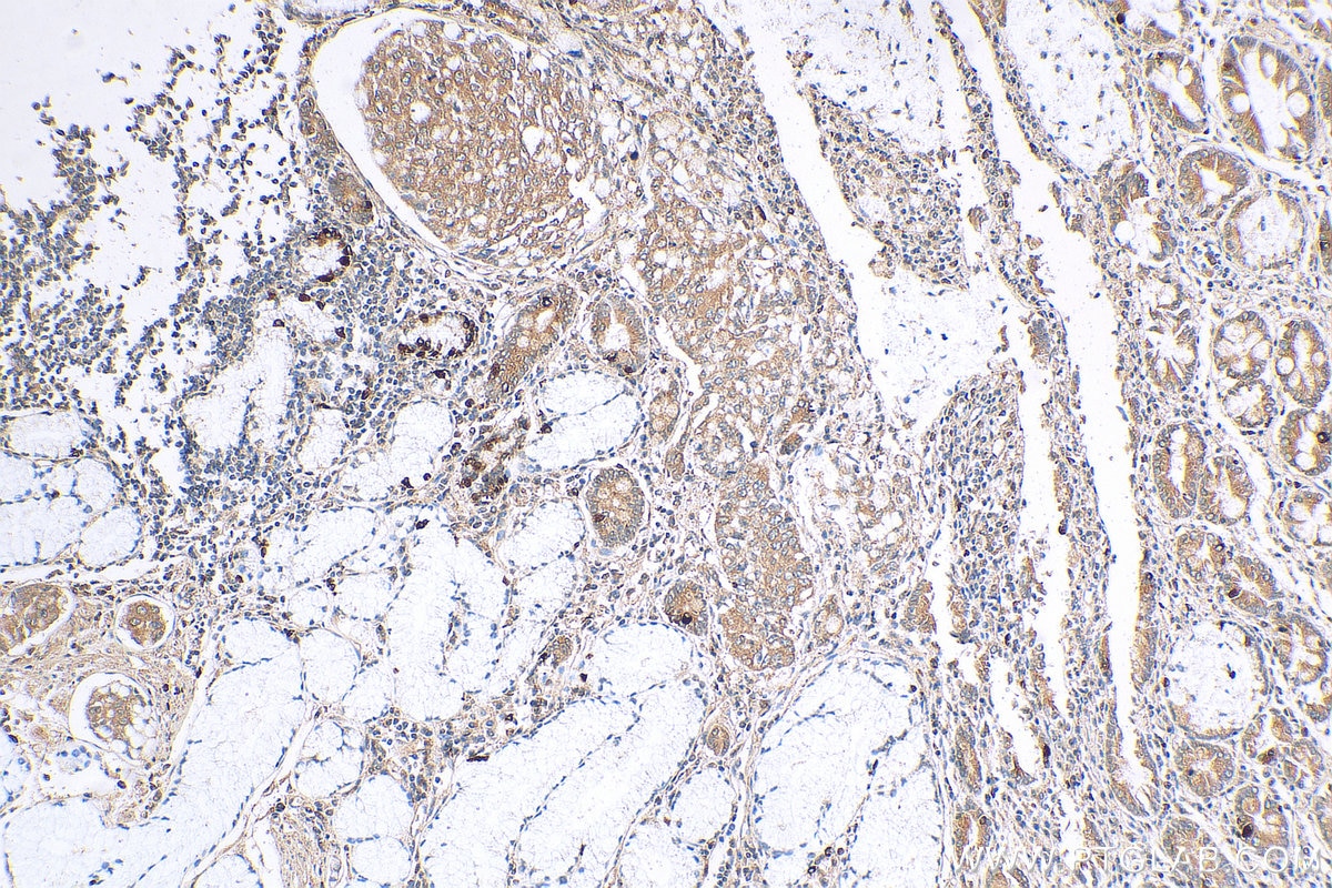 Immunohistochemistry (IHC) staining of human stomach cancer tissue using GPAA1 Polyclonal antibody (10104-1-AP)