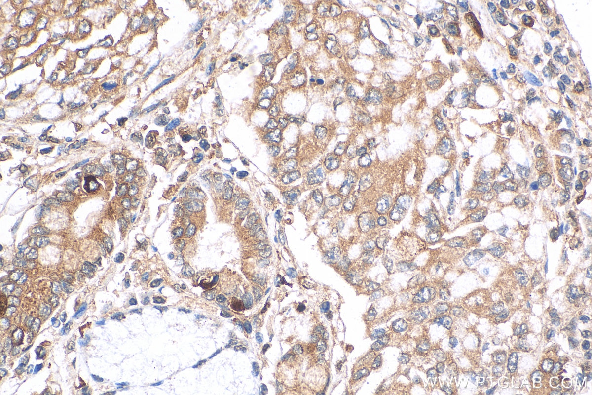 Immunohistochemistry (IHC) staining of human stomach cancer tissue using GPAA1 Polyclonal antibody (10104-1-AP)