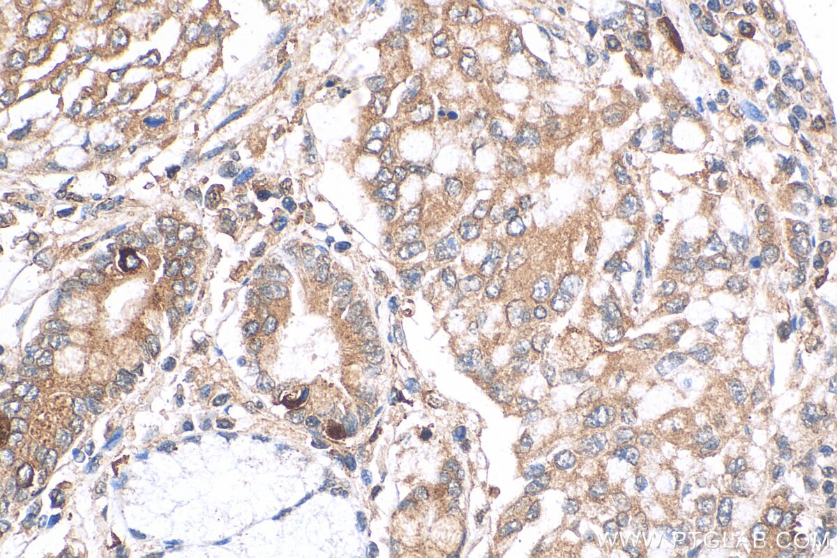 Immunohistochemistry (IHC) staining of human stomach cancer tissue using GPAA1 Polyclonal antibody (10104-1-AP)