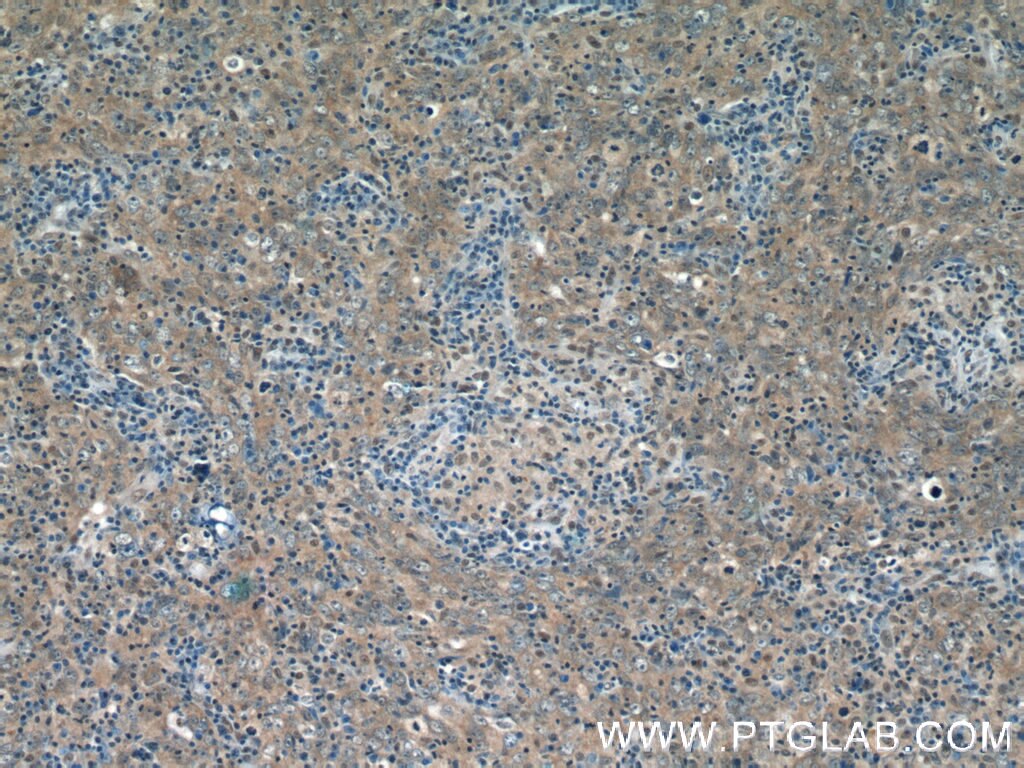 Immunohistochemistry (IHC) staining of human breast cancer tissue using GPATCH2 Polyclonal antibody (24366-1-AP)