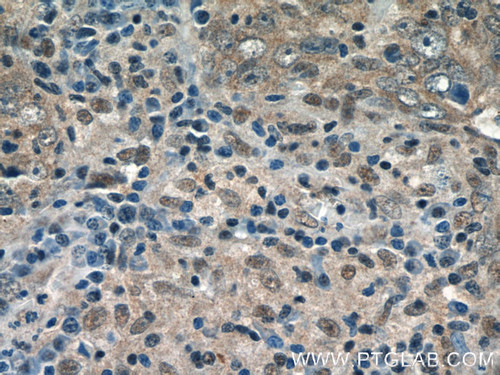 Immunohistochemistry (IHC) staining of human breast cancer tissue using GPATCH2 Polyclonal antibody (24366-1-AP)