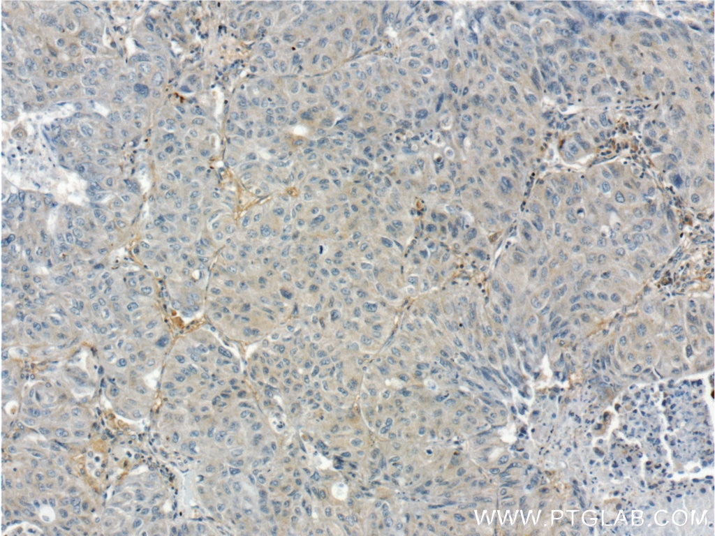 Immunohistochemistry (IHC) staining of human lung cancer tissue using GPATCH2 Polyclonal antibody (24366-1-AP)