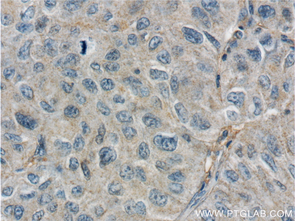 Immunohistochemistry (IHC) staining of human lung cancer tissue using GPATCH2 Polyclonal antibody (24366-1-AP)