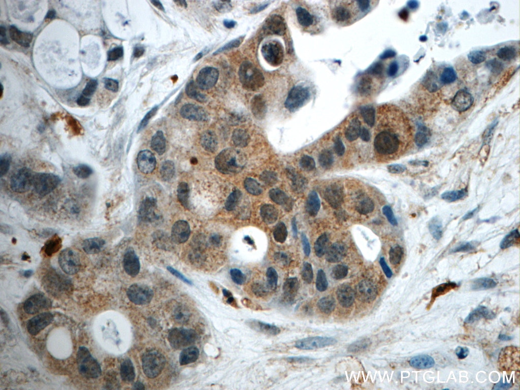 Immunohistochemistry (IHC) staining of human liver cancer tissue using GPATCH4 Polyclonal antibody (24399-1-AP)