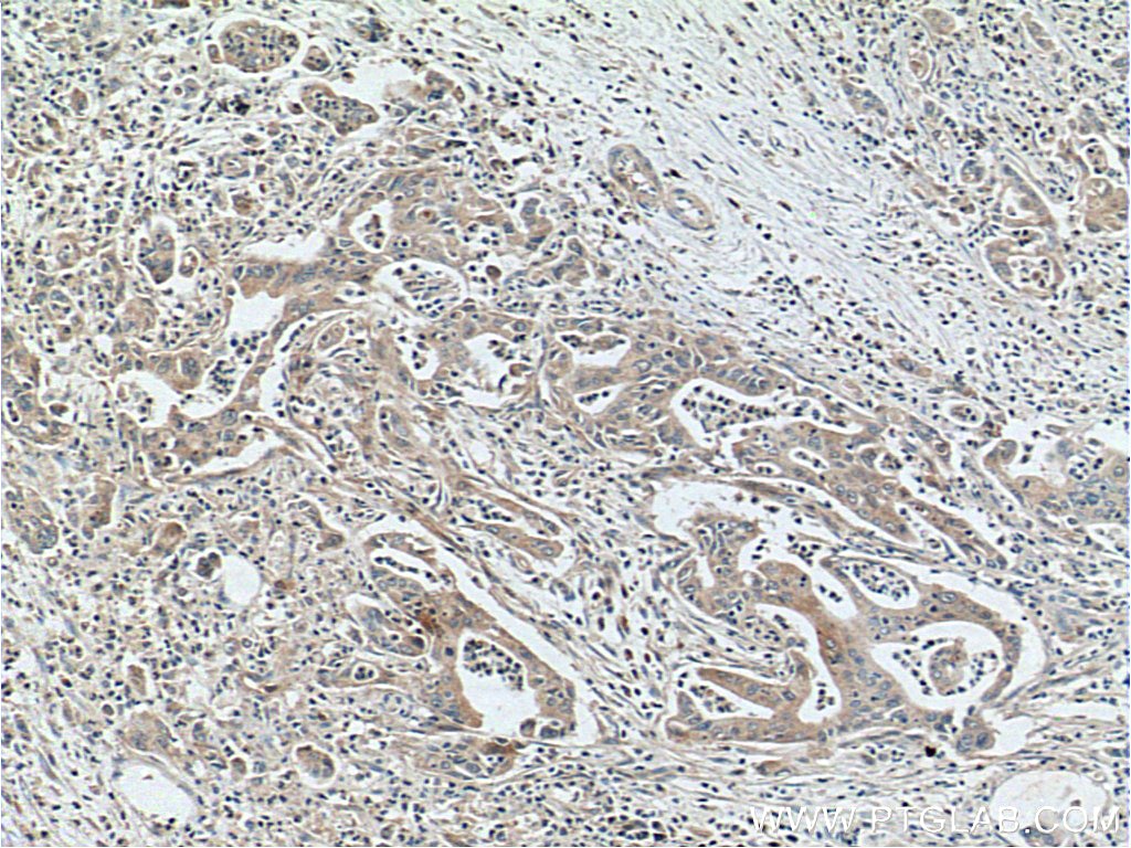 Immunohistochemistry (IHC) staining of human pancreas cancer tissue using Glypican 1 Polyclonal antibody (16700-1-AP)