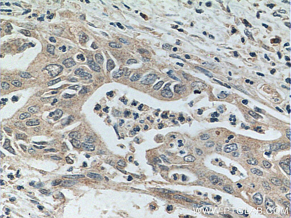 Immunohistochemistry (IHC) staining of human pancreas cancer tissue using Glypican 1 Polyclonal antibody (16700-1-AP)