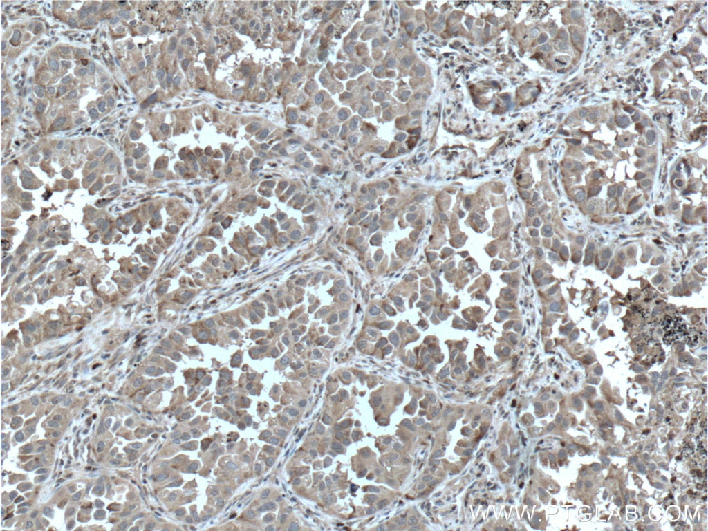 Immunohistochemistry (IHC) staining of human lung cancer tissue using GPI Polyclonal antibody (15171-1-AP)