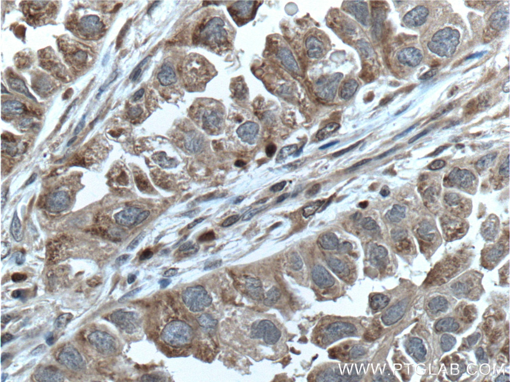 Immunohistochemistry (IHC) staining of human lung cancer tissue using GPI Polyclonal antibody (15171-1-AP)