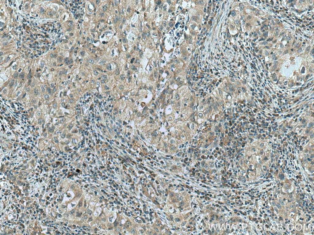 Immunohistochemistry (IHC) staining of human lung cancer tissue using GPI Monoclonal antibody (67178-1-Ig)