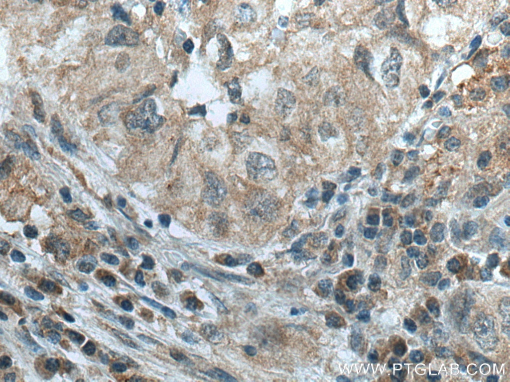 Immunohistochemistry (IHC) staining of human lung cancer tissue using GPI Monoclonal antibody (67178-1-Ig)