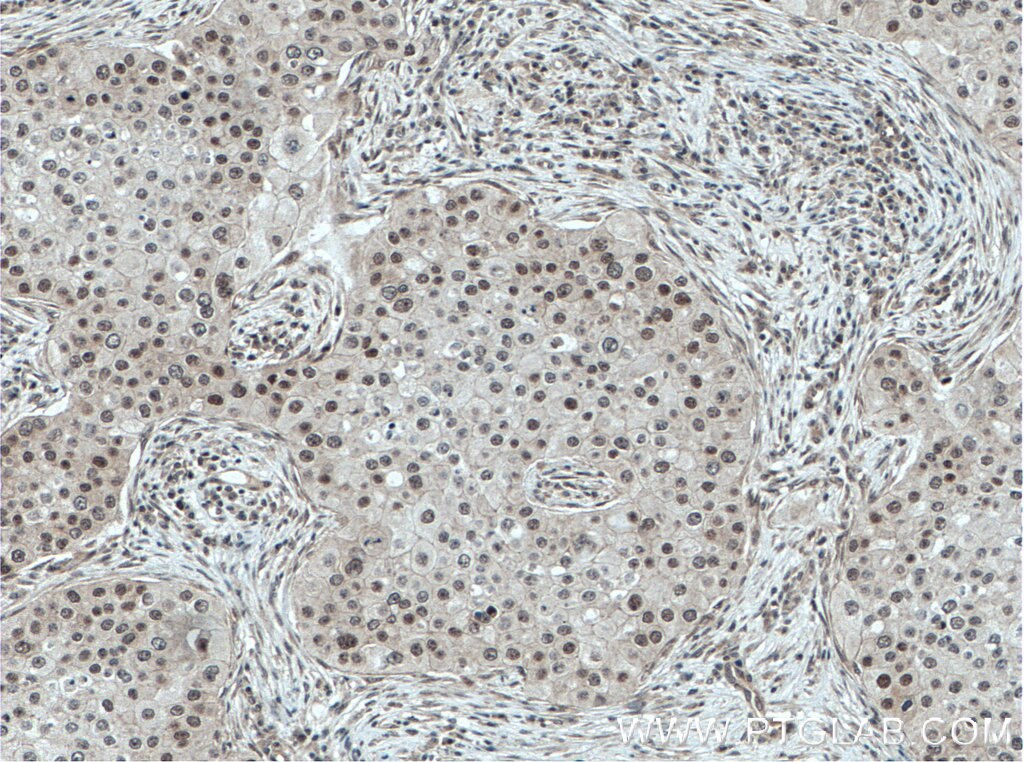Immunohistochemistry (IHC) staining of human breast cancer tissue using GPKOW Polyclonal antibody (14728-1-AP)