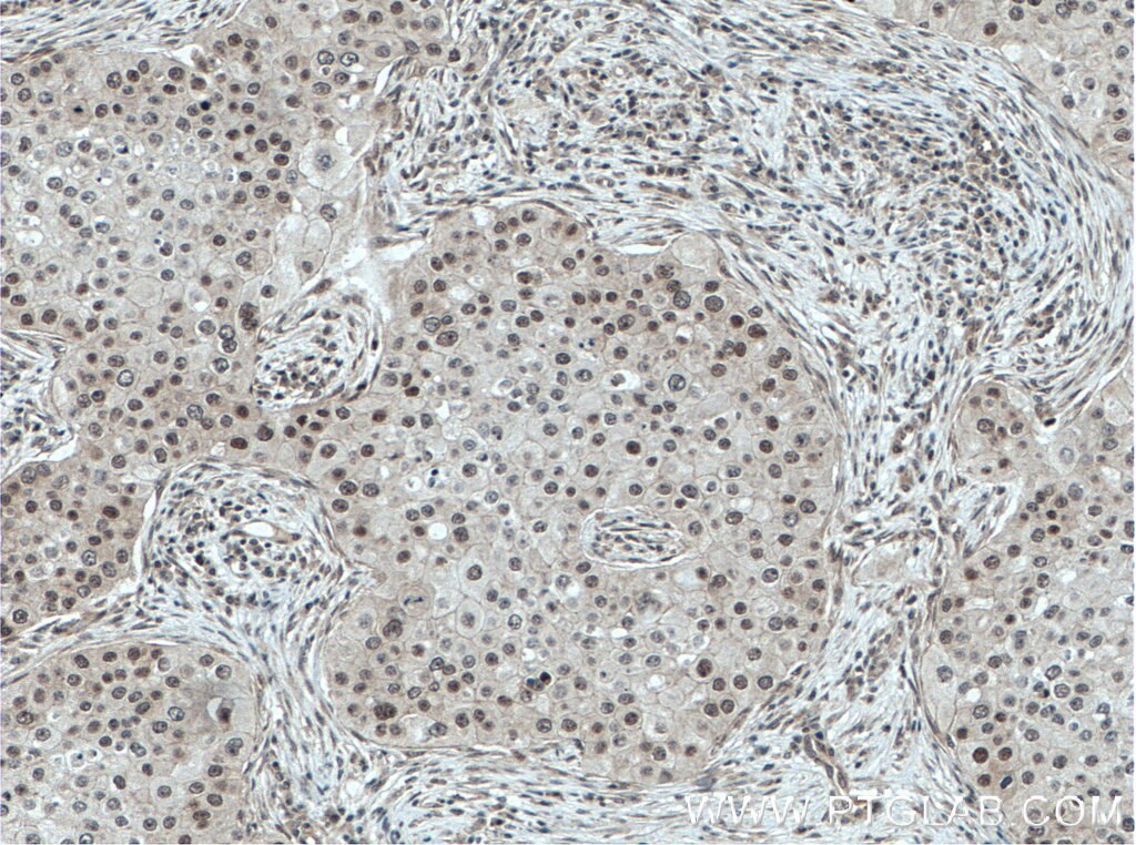 IHC staining of human breast cancer using 14728-1-AP