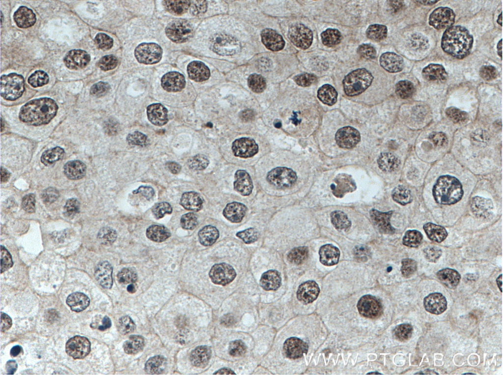 IHC staining of human breast cancer using 14728-1-AP
