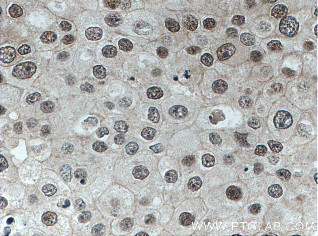 Immunohistochemistry (IHC) staining of human breast cancer tissue using GPKOW Polyclonal antibody (14728-1-AP)