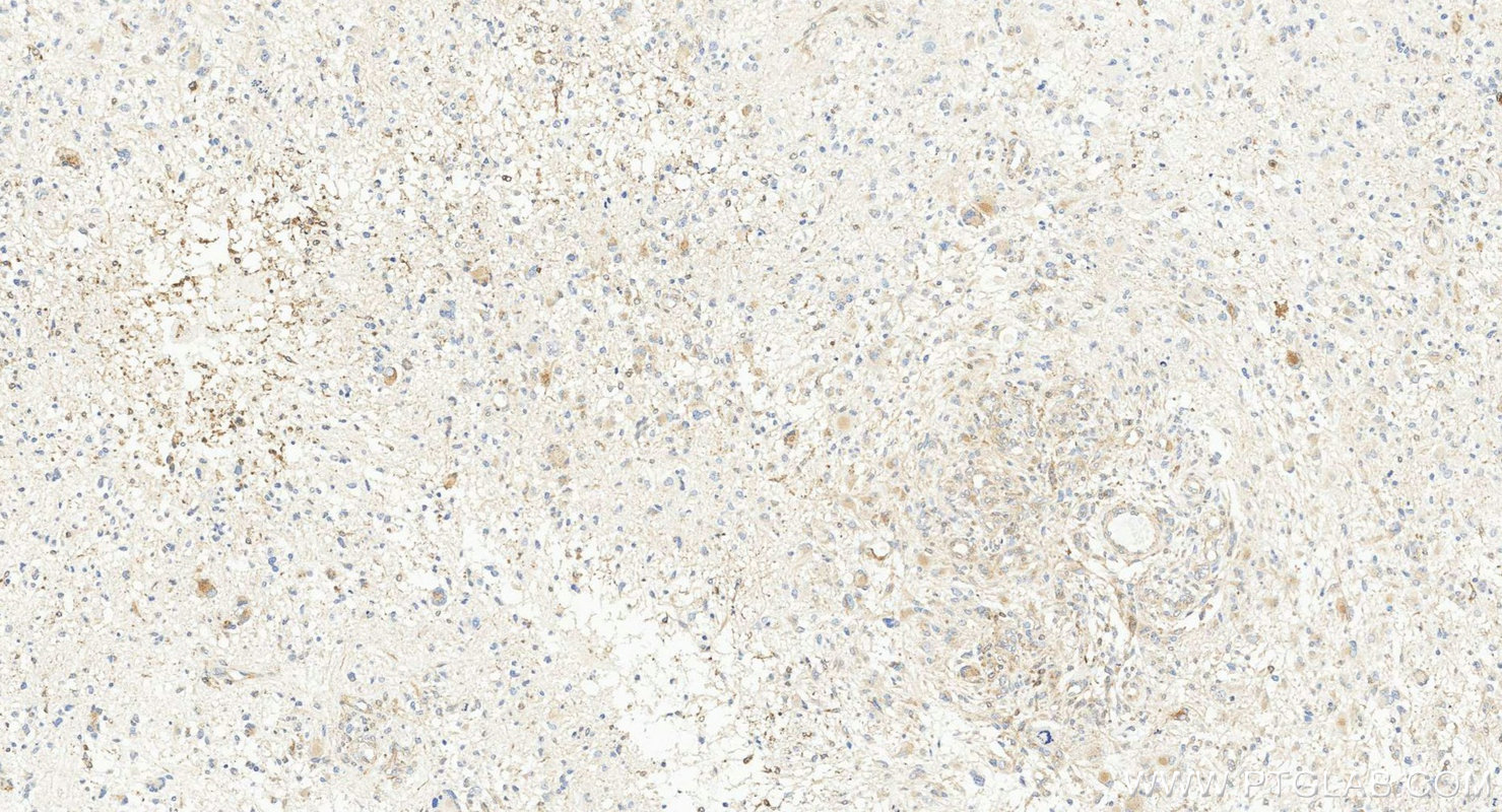 IHC staining of human gliomas using 84160-3-RR (same clone as 84160-3-PBS) Immunohistochemistry (IHC) staining of human gliomas tissue using GPNMB Recombinant monoclonal antibody (84160-3-RR)