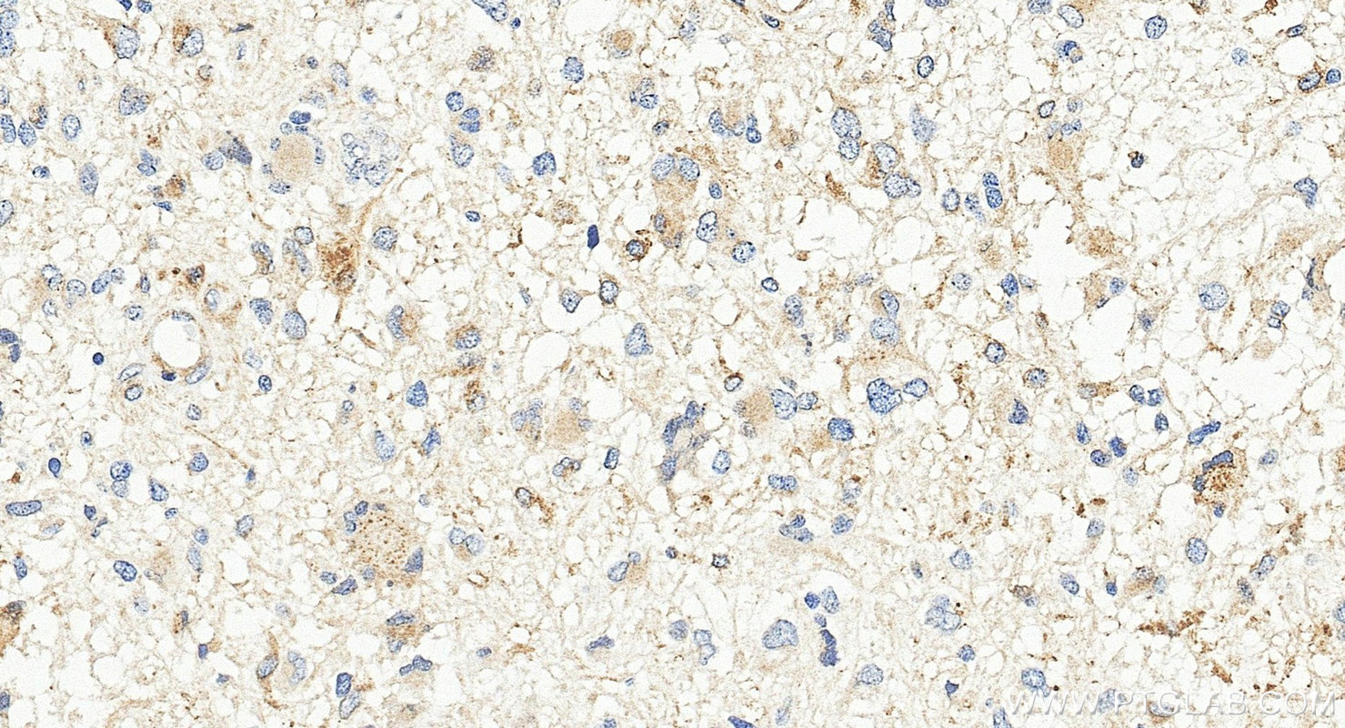 IHC staining of human gliomas using 84160-3-RR (same clone as 84160-3-PBS) Immunohistochemistry (IHC) staining of human gliomas tissue using GPNMB Recombinant monoclonal antibody (84160-3-RR)