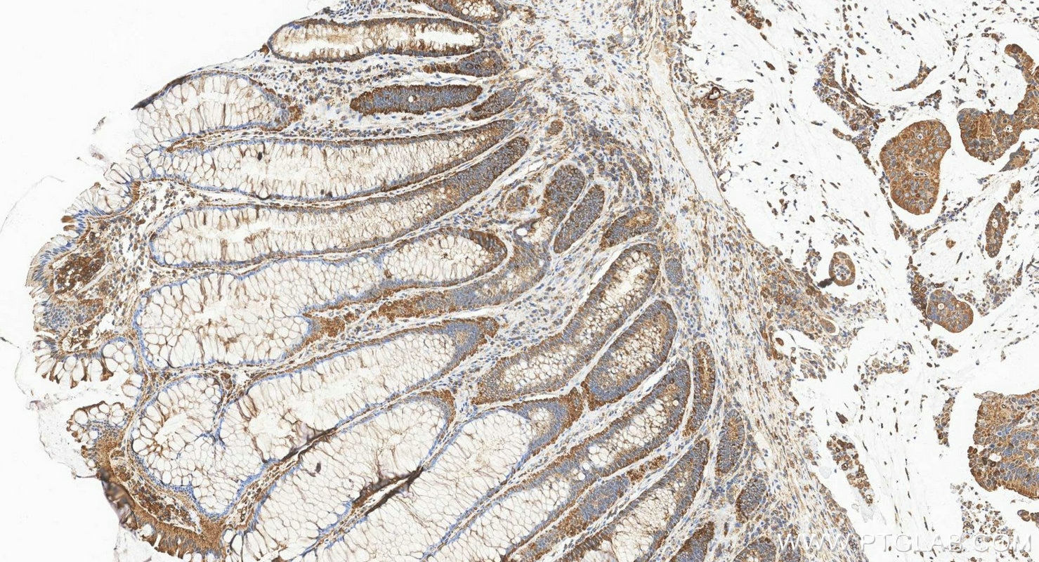 IHC staining of human colon cancer using 84160-3-RR (same clone as 84160-3-PBS) Immunohistochemistry (IHC) staining of human colon cancer tissue using GPNMB Recombinant monoclonal antibody (84160-3-RR)