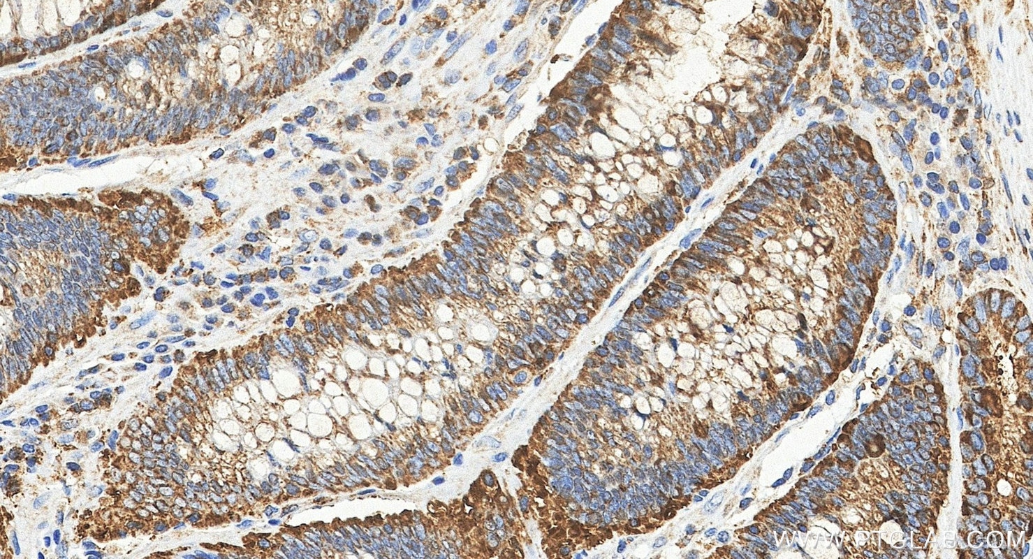 IHC staining of human colon cancer using 84160-3-RR (same clone as 84160-3-PBS) Immunohistochemistry (IHC) staining of human colon cancer tissue using GPNMB Recombinant monoclonal antibody (84160-3-RR)