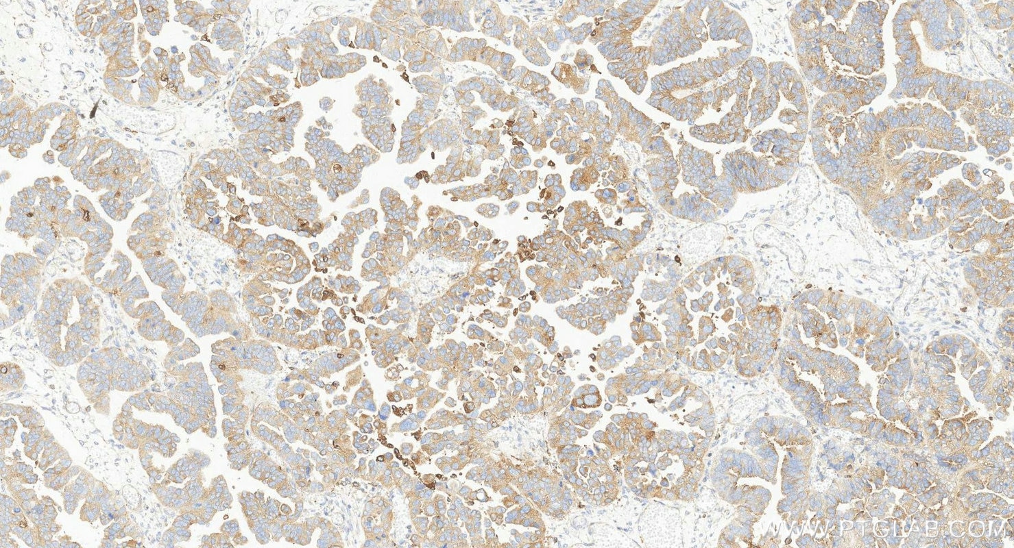 IHC staining of human ovary cancer using 84160-3-RR (same clone as 84160-3-PBS) Immunohistochemistry (IHC) staining of human ovary cancer tissue using GPNMB Recombinant monoclonal antibody (84160-3-RR)