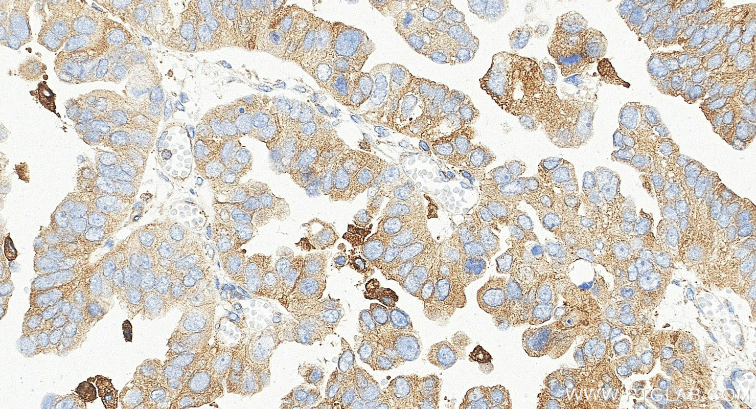 IHC staining of human ovary cancer using 84160-3-RR (same clone as 84160-3-PBS) Immunohistochemistry (IHC) staining of human ovary cancer tissue using GPNMB Recombinant monoclonal antibody (84160-3-RR)
