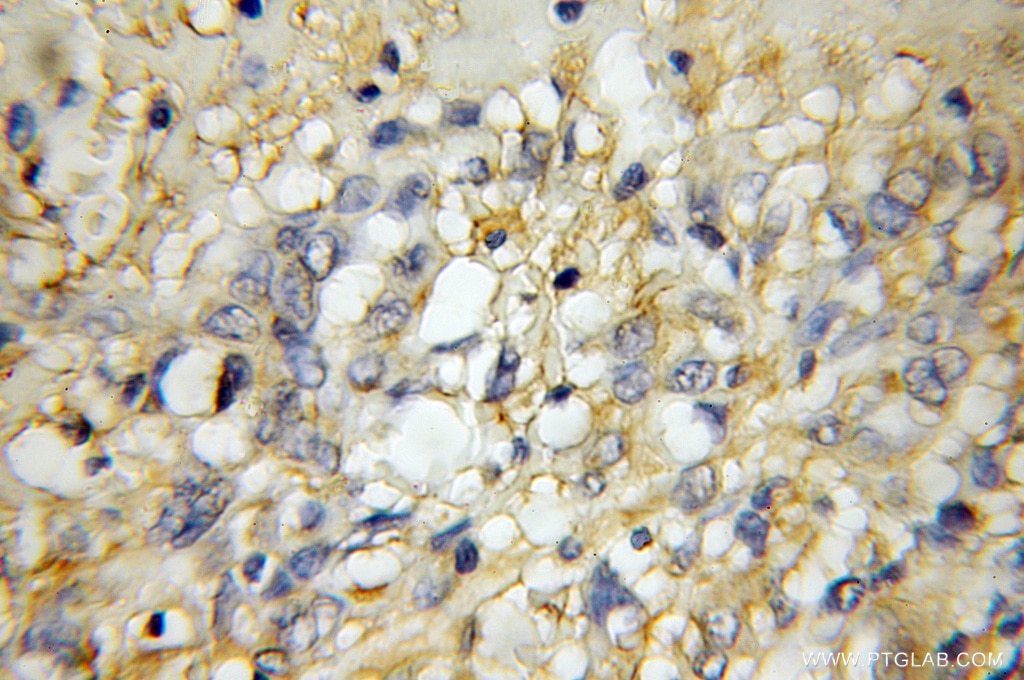 IHC staining of human gliomas using 11929-1-AP