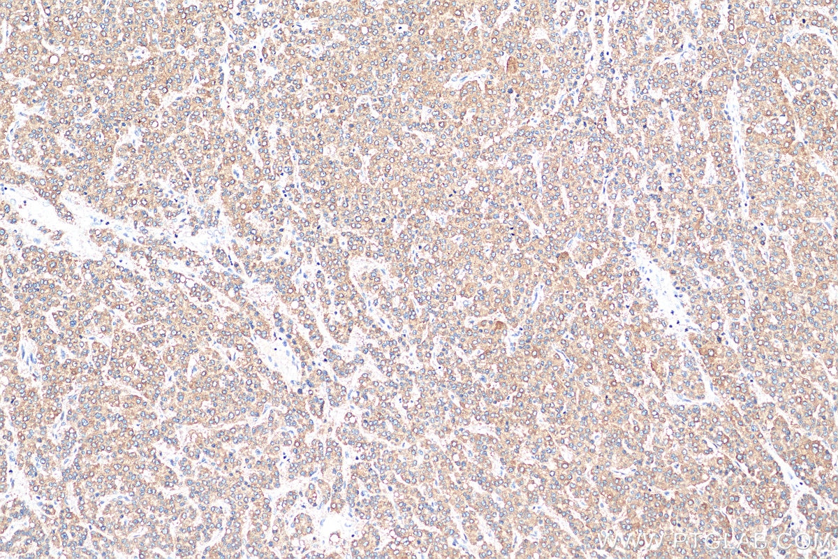 Immunohistochemistry (IHC) staining of human liver cancer tissue using GPR137B Polyclonal antibody (16496-1-AP)