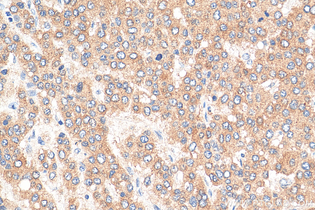 Immunohistochemistry (IHC) staining of human liver cancer tissue using GPR137B Polyclonal antibody (16496-1-AP)