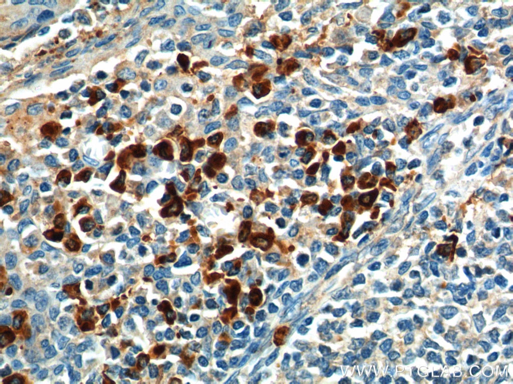 Immunohistochemistry (IHC) staining of human tonsillitis tissue using GPR171 Polyclonal antibody (20307-1-AP)