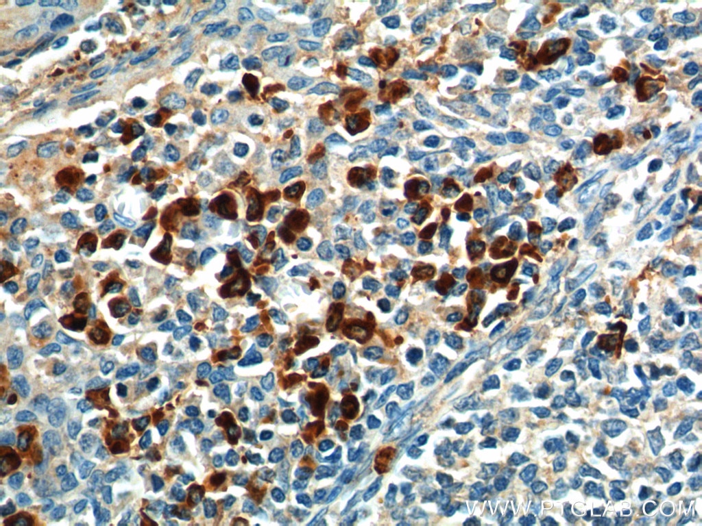 IHC staining of human tonsillitis using 20307-1-AP