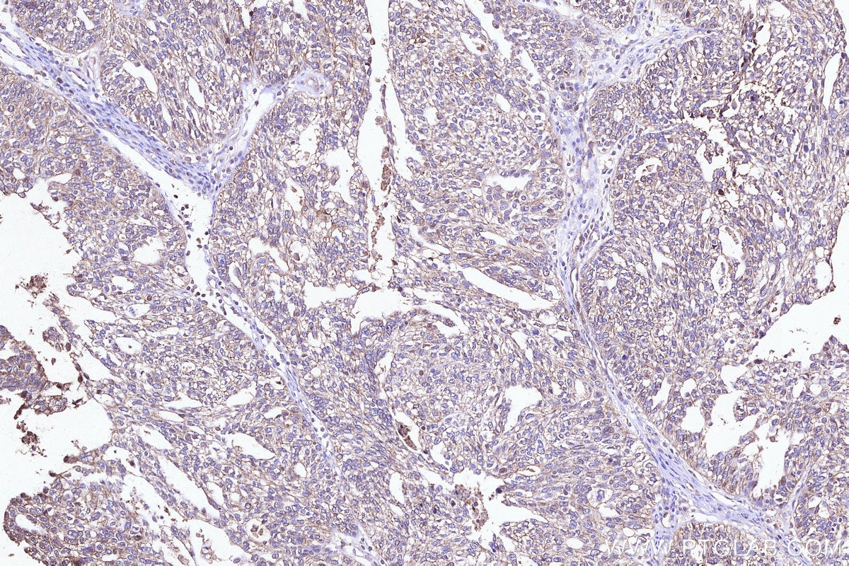 IHC staining of human ovary cancer using 33499-1-AP Immunohistochemistry (IHC) staining of human ovary cancer tissue using GPR175 Polyclonal antibody (33499-1-AP)