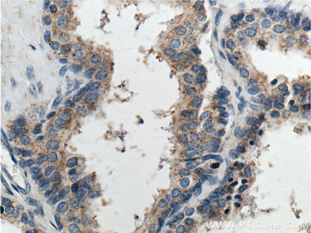 Immunohistochemistry (IHC) staining of human prostate hyperplasia tissue using GPR21 Polyclonal antibody (17973-1-AP)