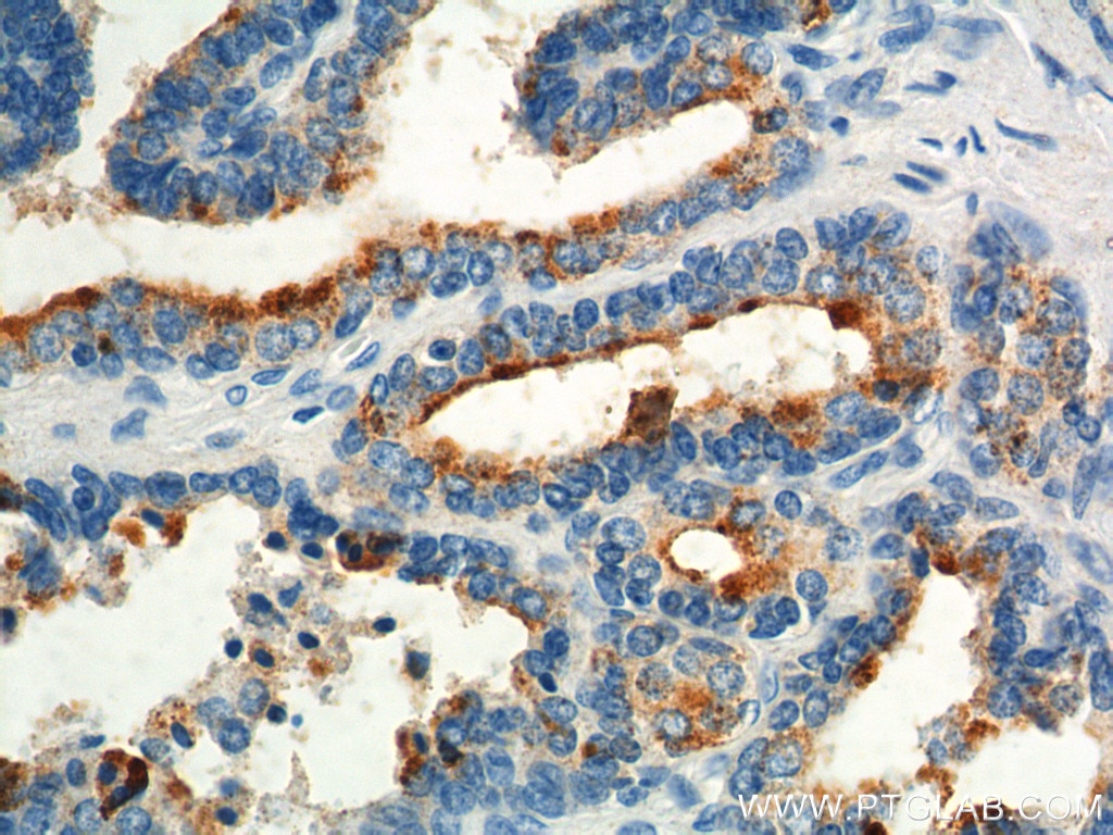 Immunohistochemistry (IHC) staining of human prostate hyperplasia tissue using GPR55 Polyclonal antibody (55249-1-AP)