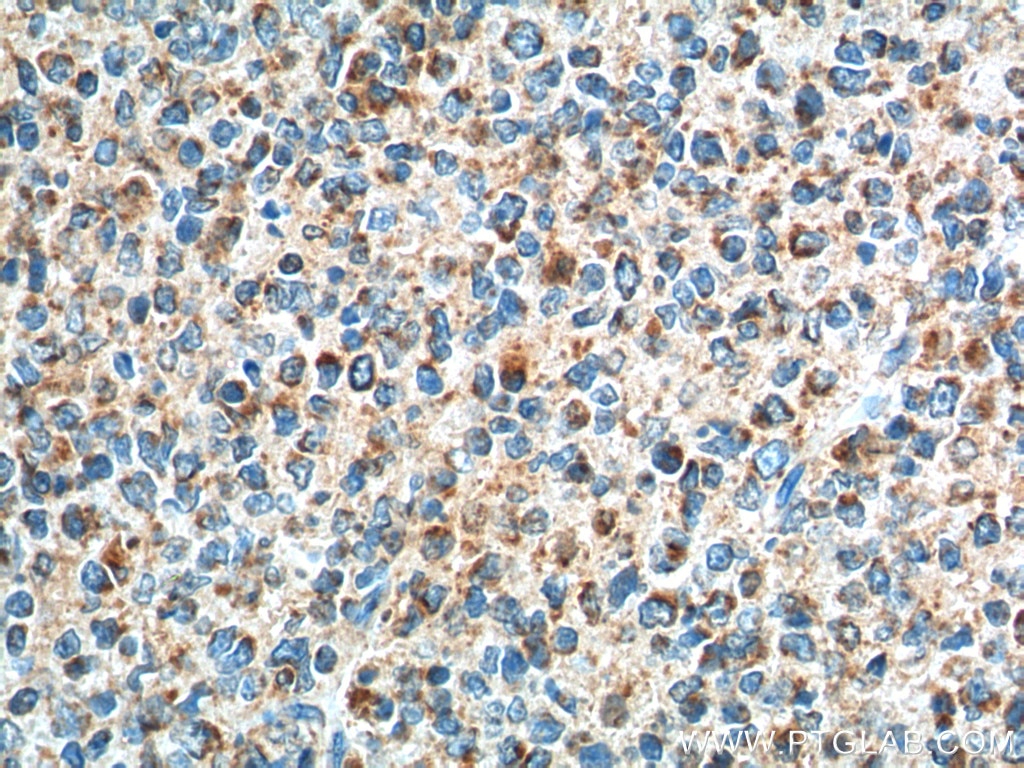 Immunohistochemistry (IHC) staining of human tonsillitis tissue using GPR65 Polyclonal antibody (20306-1-AP)