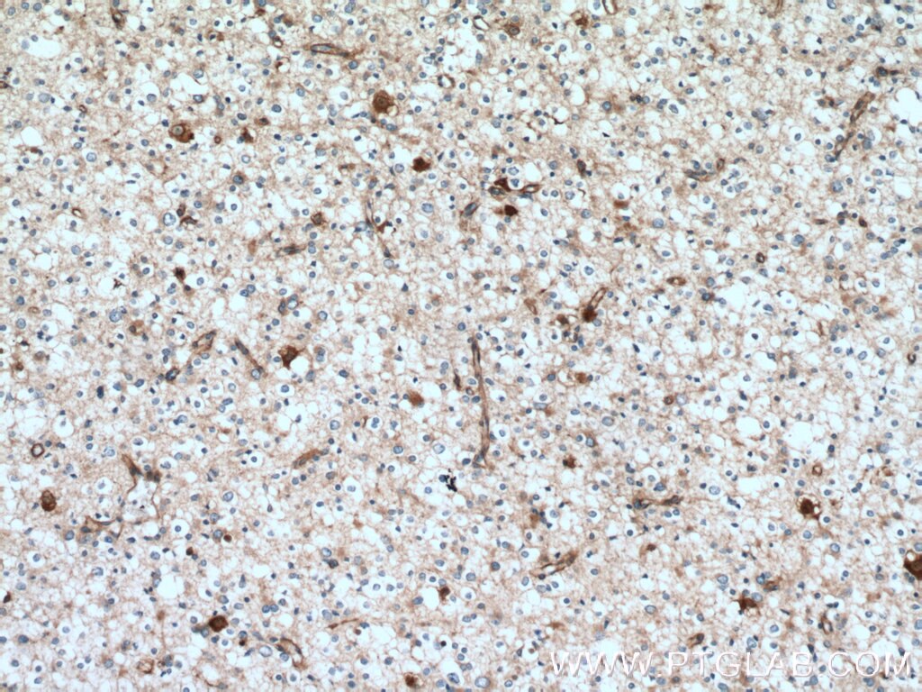 Immunohistochemistry (IHC) staining of human gliomas tissue using GPRASP2 Polyclonal antibody (12159-1-AP)