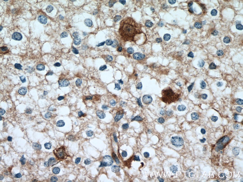 Immunohistochemistry (IHC) staining of human gliomas tissue using GPRASP2 Polyclonal antibody (12159-1-AP)