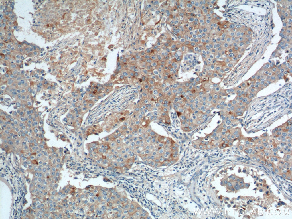 Immunohistochemistry (IHC) staining of human breast cancer tissue using GPRC5A,RAI3 Polyclonal antibody (10309-1-AP)