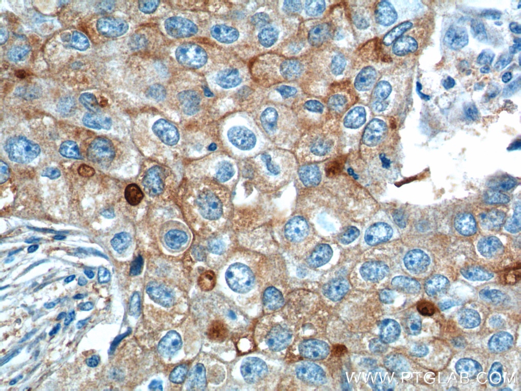 Immunohistochemistry (IHC) staining of human breast cancer tissue using GPRC5A,RAI3 Polyclonal antibody (10309-1-AP)