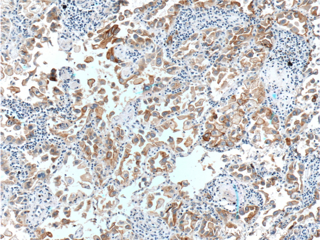 Immunohistochemistry (IHC) staining of human lung cancer tissue using GPRC5A,RAI3 Polyclonal antibody (10309-1-AP)