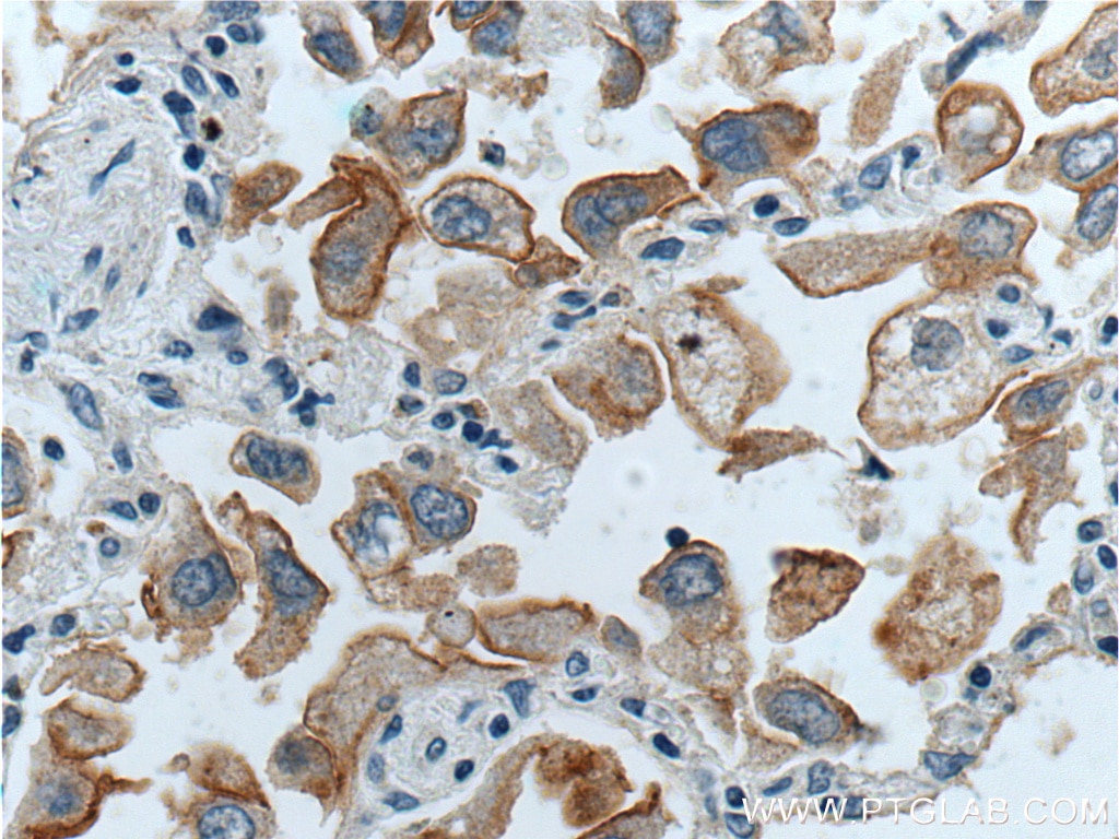 Immunohistochemistry (IHC) staining of human lung cancer tissue using GPRC5A,RAI3 Polyclonal antibody (10309-1-AP)