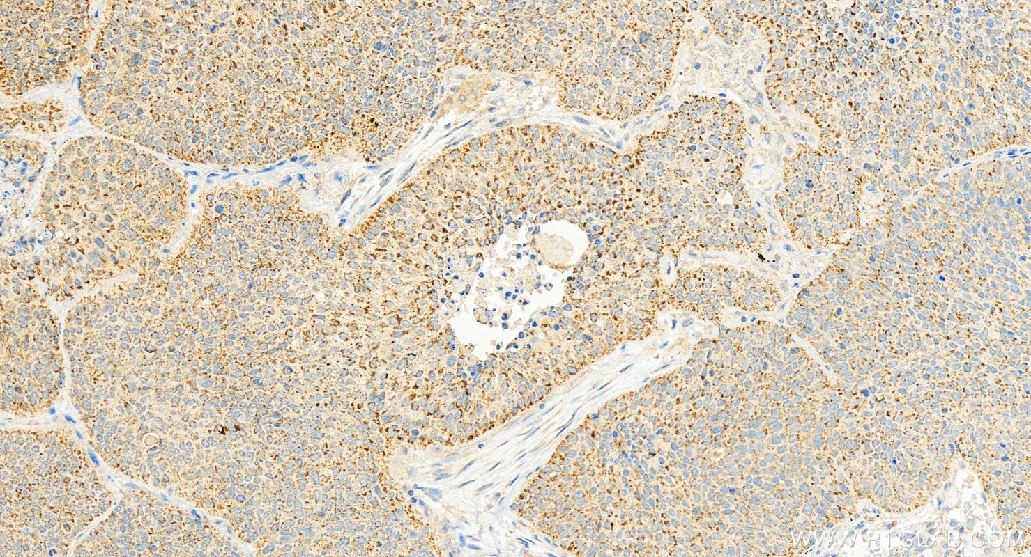 Immunohistochemistry (IHC) staining of human lung squamous cell carcinoma tissue using GPRC5A,RAI3 Polyclonal antibody (10309-1-AP)