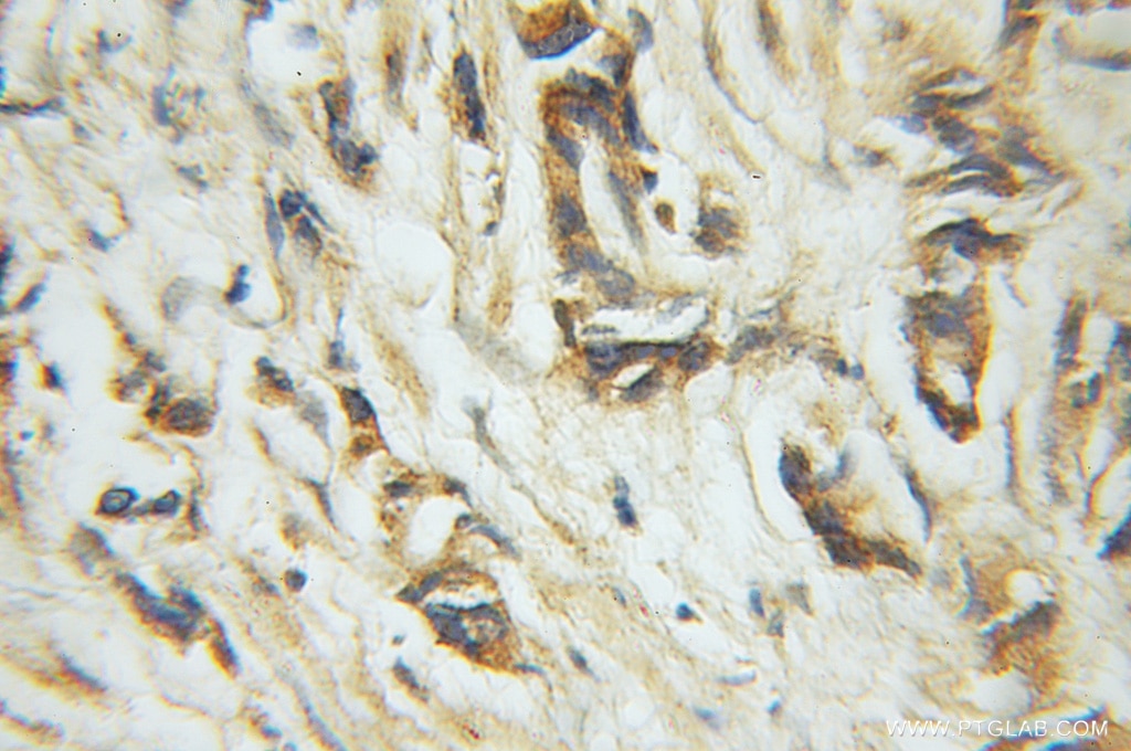 Immunohistochemistry (IHC) staining of human prostate cancer tissue using CSN1 Polyclonal antibody (11709-1-AP)
