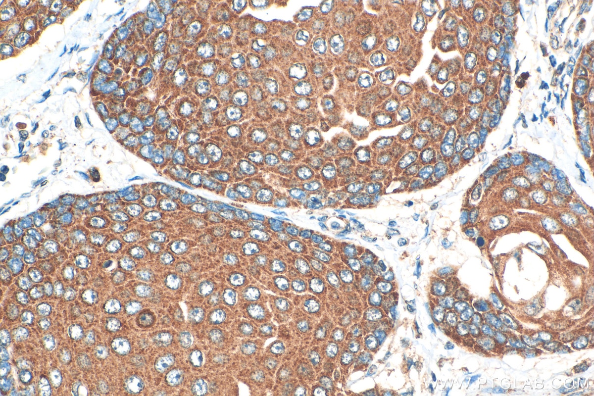 Immunohistochemistry (IHC) staining of human oesophagus cancer tissue using GPSM1 Polyclonal antibody (11483-1-AP)