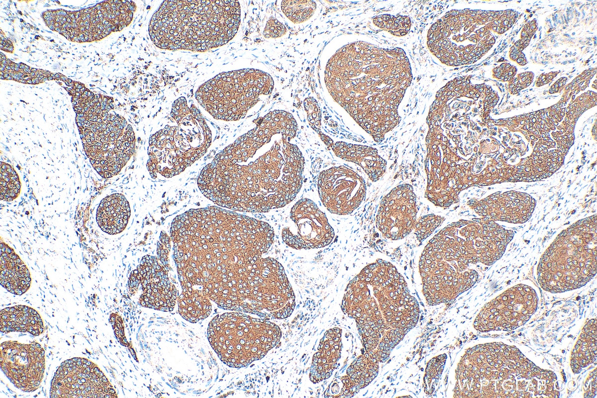 IHC staining of human oesophagus cancer using 11483-1-AP